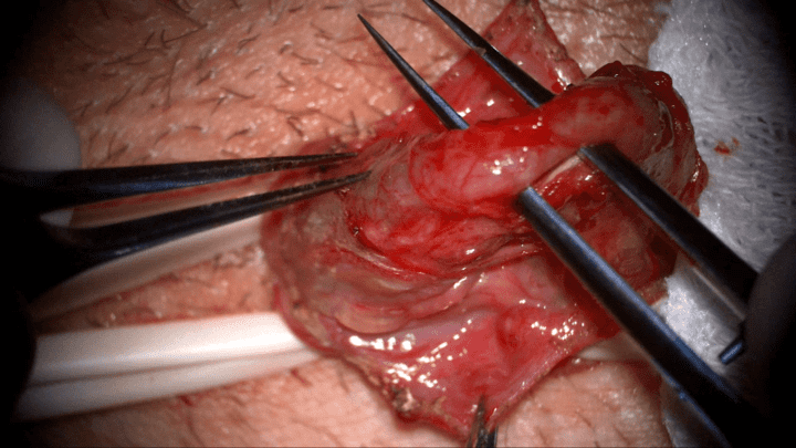 varicocele_disseccao_da_veia